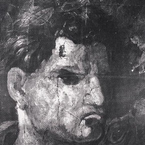 Figure 4: X-radiograph from blinding of Elymas